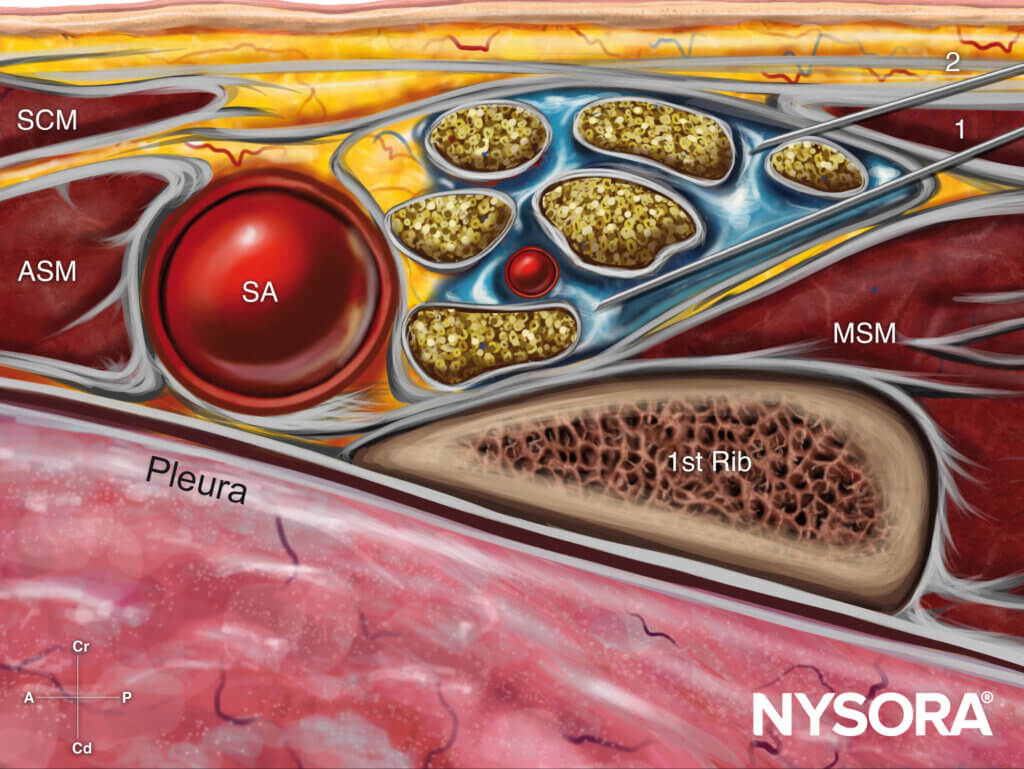 New update! Liposomal Bupivacaine in Supraclavicular Blocks: Does It Improve Pain Relief?