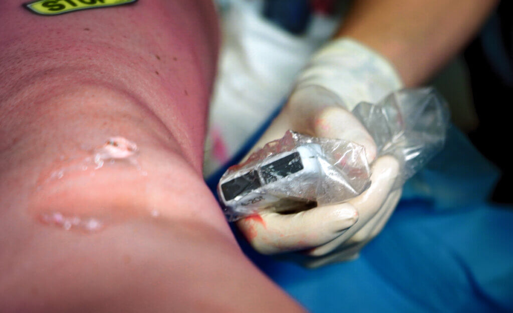 Alert: Infections from non-sterile ultrasound gel!