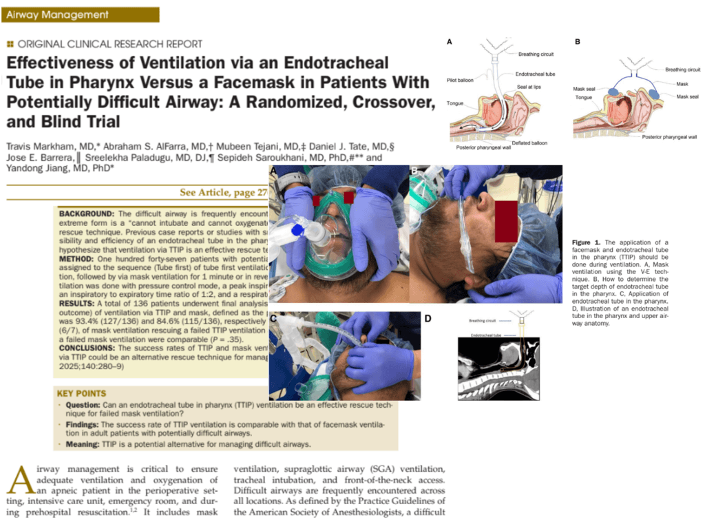 Pharyngeal Endotracheal Tube Ventilation (TTIP) in Difficult Airways